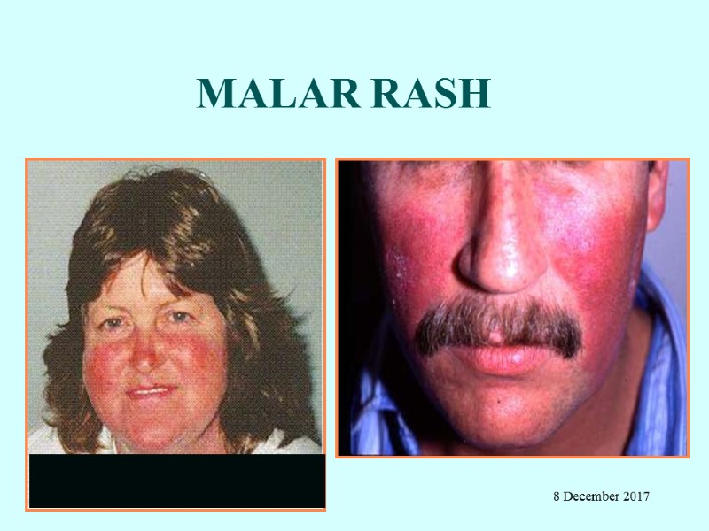 MALAR RASH 8 December 2017